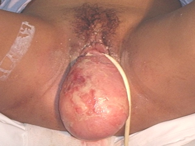 Figura 1. Imagen clnica macroscpica externa de la lesin, con implantacin vaginal.